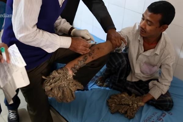 Čovek-drvo izlečen posle 16 operacija: Nisam mislio da ću ikada više moći da držim svoju decu u rukama (VIDEO)