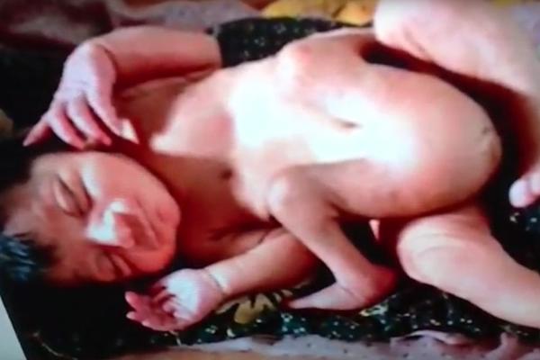 Ovo (ne) želite da vidite! Rođena beba s 4 noge i 2 penisa! (VIDEO)