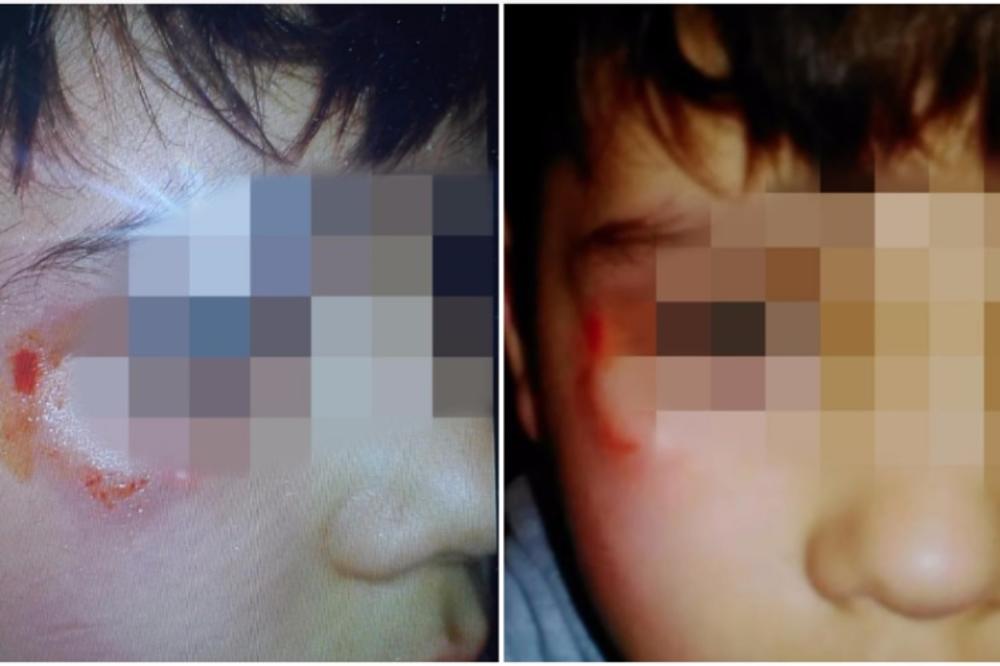 MAMA BOLI ME, A SUZE ME PEKU: Sin joj godinu i po dana iz škole dolazi u modricama! I NIKO NE REAGUJE! (FOTO)