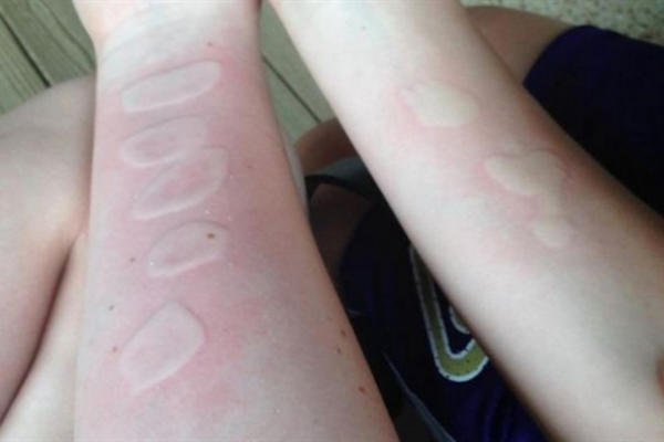 FATALAN IZAZOV: Nova igra među klincima ostavlja stravične posledice! Roditelji, odmah pregledajte ruke vašoj deci! (FOTO)