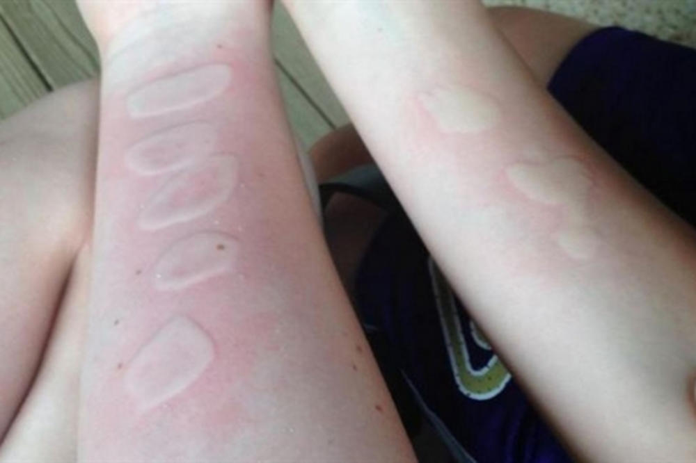 FATALAN IZAZOV: Nova igra među klincima ostavlja stravične posledice! Roditelji, odmah pregledajte ruke vašoj deci! (FOTO)