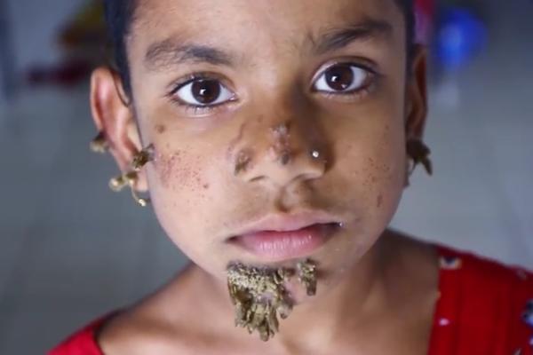 Devojčica iz Bangladeša prva ženska osoba koje je ČOVEK-DRVO! (FOTO) (VIDEO)