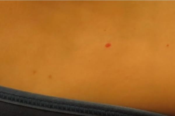 Imate ovakve TAČKICE po KOŽI? Proverite da li su opasne! (FOTO)