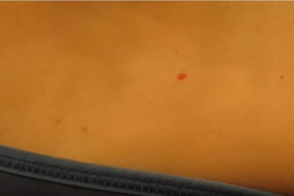 Imate ovakve TAČKICE po KOŽI? Proverite da li su opasne! (FOTO)