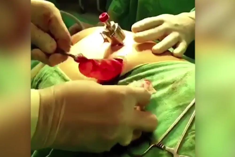 Indijka trpela nesnosan bol u stomaku, ONO ŠTO SU NAŠLI JE ZA GINISA!