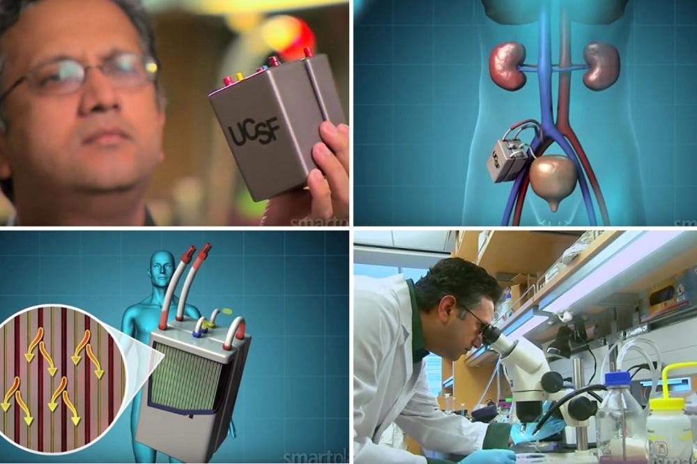 Neće biti više dijalize, razvijen bionički bubreg! (FOTO) (VIDEO)