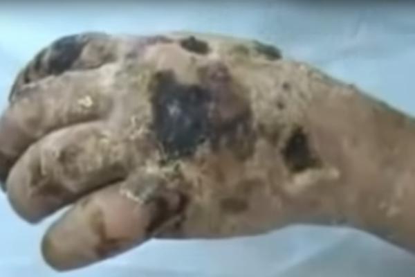 (VEOMA UZNEMIRUJUĆI VIDEO) Ovo su efekti "krokodil" droge!