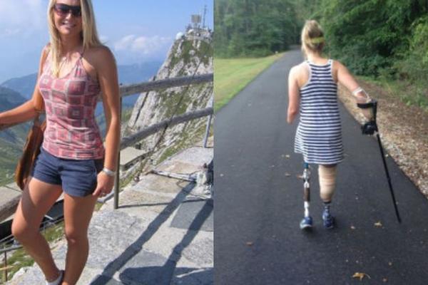 PROBUDILA SAM SE I VIDELA DA MI JE NOGA PREKO NOĆI ISTRULILA: Stravična ispovest devojke ostavlja bez reči (VIDEO)