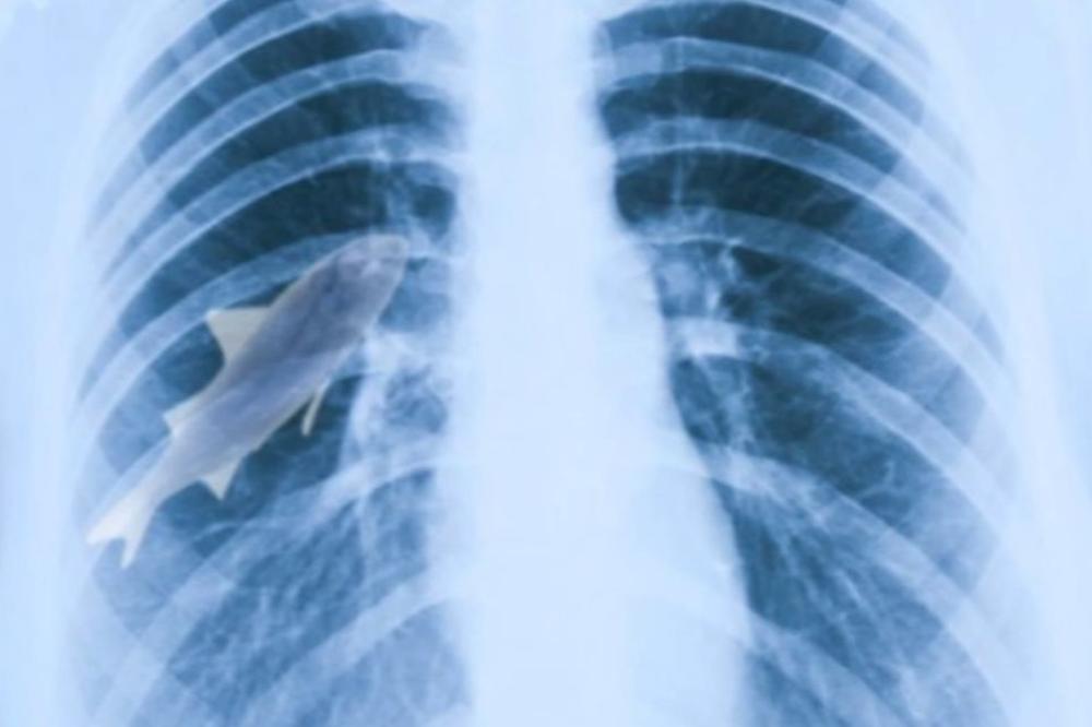 UŽAS! Ovo su 10 NAJGADNIJIH STVARI pronađenih u LJUDSKOM TELU (VIDEO)