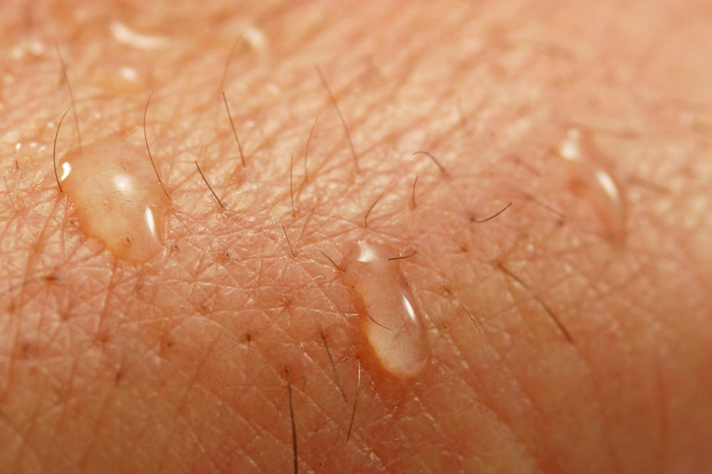 BUDITE SA ZNOJEM NA LICU? Evo na koje OZBILJNE bolesti ukazuje često znojenje!