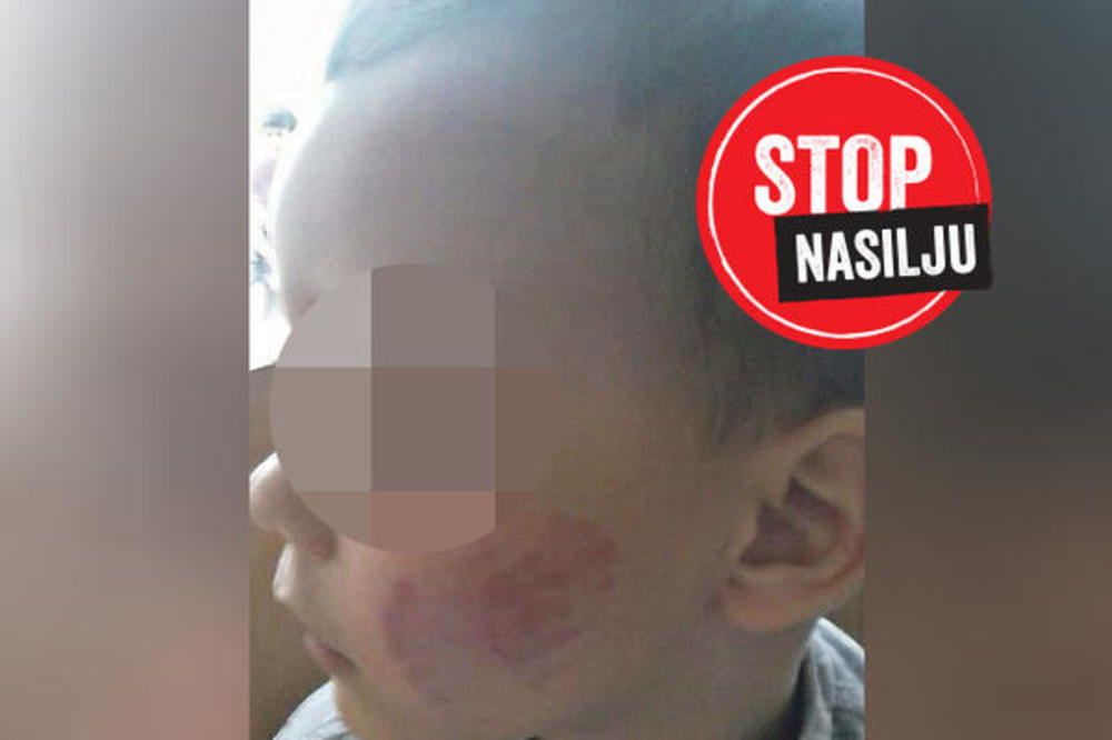 Trogodišnje dete izujedano 11 puta!? NEZAPAMĆEN INCIDENT U VALJEVSKOM VRTIĆU (FOTO)