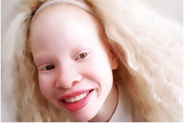 SVI SU JOJ SE SMEJALI ZBOG OVE BOLESTI, a ona im je BRUTALNO ZAPUŠILA USTA! (FOTO)