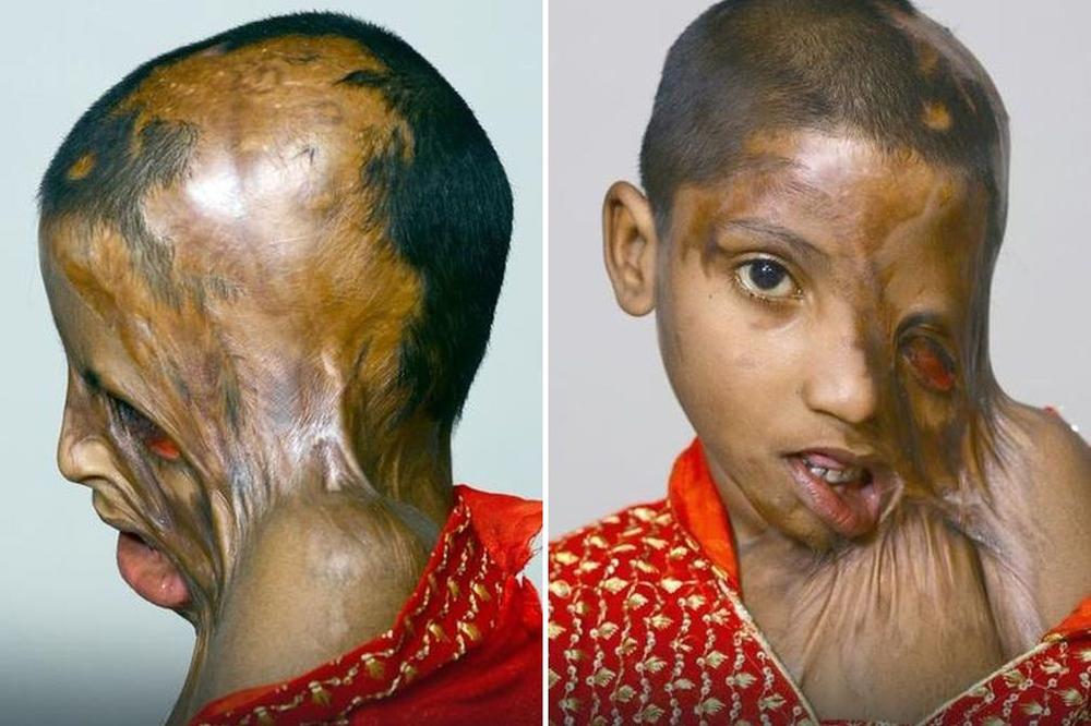 STIĆI ĆE TE KAZNA, MONSTRUME! Polio ćerku KISELINOM po glavi i UNIŠTIO joj život! (FOTO)