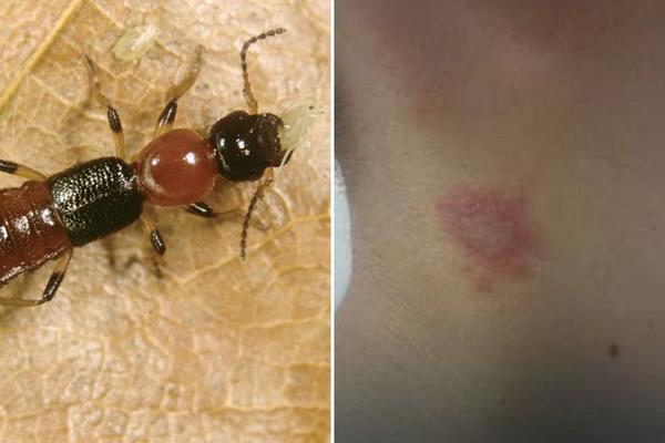 PEDERUS NAPADA SRBIJU! Čim pokušate da ga se otarasite, baca otrov na vas! (FOTO)