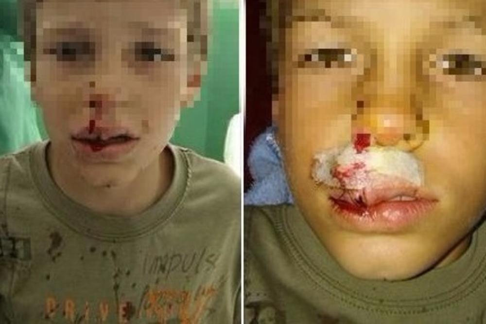 JOŠ JEDNO DETE STRADALO OD UJEDA PASA LUTALICA: Hteo je da pomazi kucu, a onda se dogodila katastrofa! (FOTO)