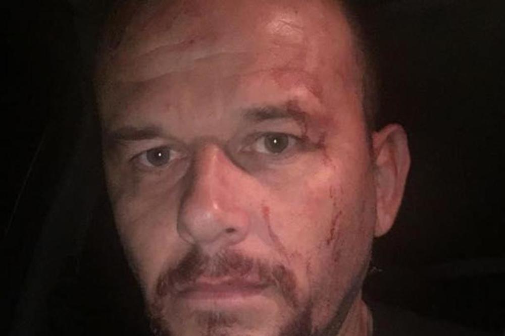 JOSIP ČAČIĆ POGOĐEN ČAŠOM U GLAVU: Pevaču razbijena glava na koncertu, morao na ušivanje