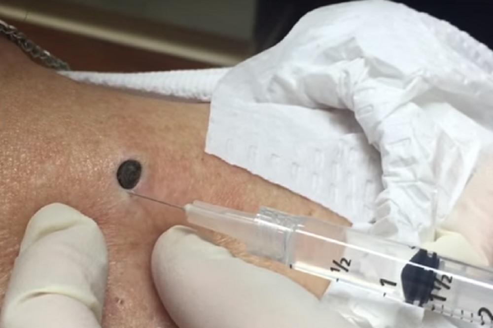 PREVRNUĆE VAM SE STOMAK: Najodvratniji mitiser ikada je ostavio krater na koži! (VIDEO)