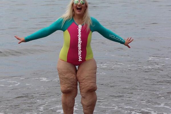 ZBOG NOGU SU JOJ SE SMEJALI SVI NA PLAŽI: Duboko sam udahnula i nasmejala se - jer oni ne znaju kroz šta sam ja prošla! (FOTO)