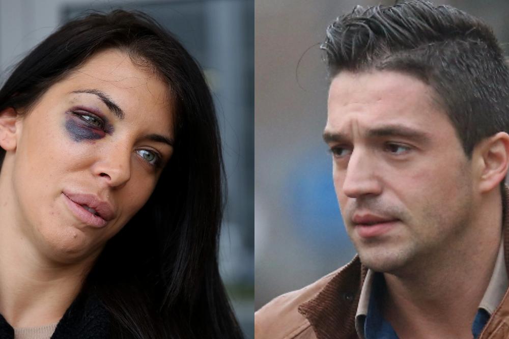 I DANAS ima POVREDE NA TELU! Pre dve godine je pretukao naš voditelj i ZAPALIO u Ameriku, fotke Ane Marije DANAS će vas iznenaditi! (FOTO)