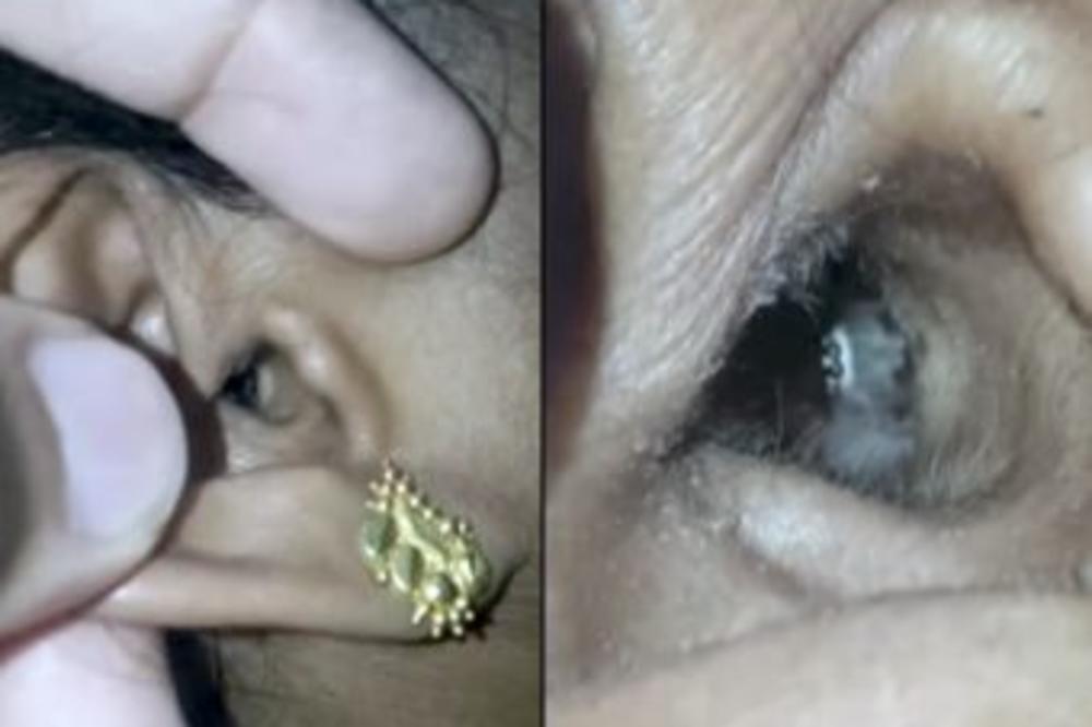 ŽALILA SE NA GLAVOBOLJU: Onda su pogledali u njeno uvo i VIDELI SU MALO LICE!