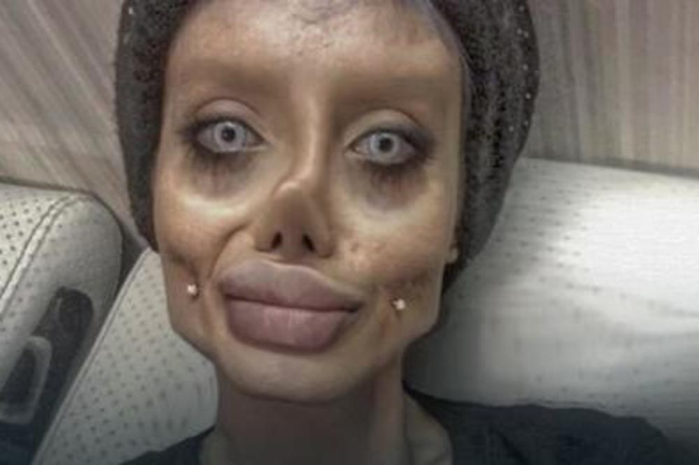 ŽELELA JE DA LIČI NA ANĐELINU DŽOLI, OPERISALA SE 50 PUTA, SADA JE ZOVU HODAJUĆI KOSTUR! Evo kako je izgledala pre svih operacija! (FOTO)