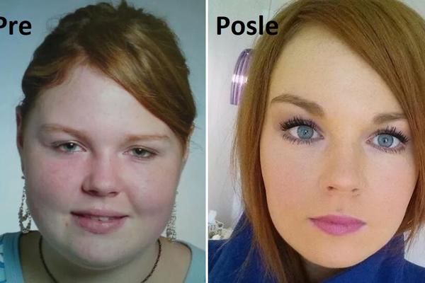 Gubljenje kilograma je lako, ali šta je sa licem? 10 fotki ljudi koji su smršali, i to MNOGO! (FOTO)