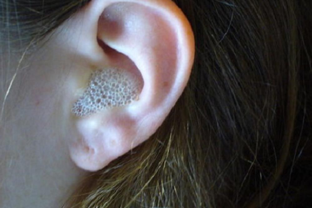GENIJALAN SAVET OTOLARINGOLOGA: Kako da jednostavno isperete zapušene uši?