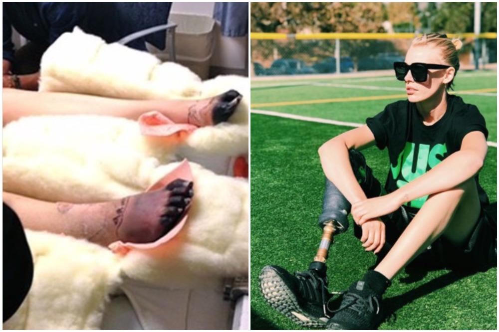 PRVO JE MISLILA DA IMA GRIP: Manekenka zbog TAMPONA izgubila desnu nogu, a sada će i drugu!