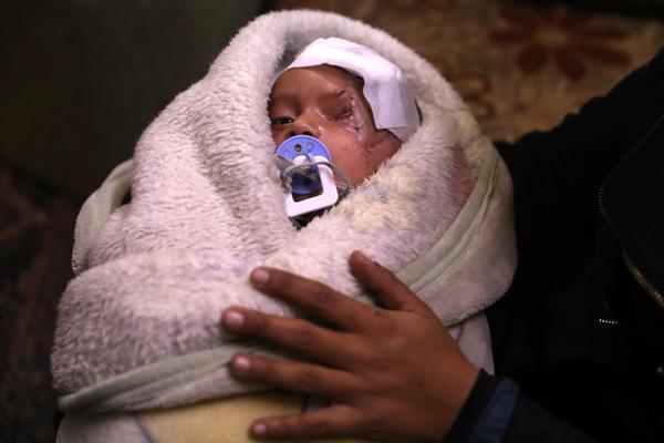 CEO SVET POKRIVA JEDNO OKO ZBOG OVOG DEČAKA: Mali Karim je simbol svih žrtava sukoba u SIRIJI!