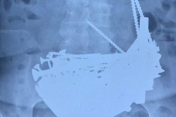 ČIM SU VIDELI STOMAK OVE RUSKINJE, ODMAH SU ZAKAZALI HITNU OPERACIJU: Ono što su pronašli, šokiralo je celu Rusiju!