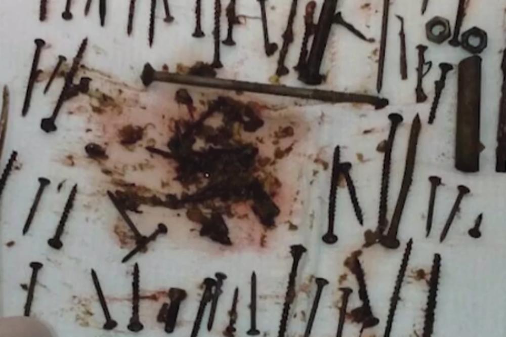 BABA POJELA KILOGRAM METALA: U stomaku starice hirurzi pronašli 152 EKSERA, ŠRAFOVA I JEDNU KVAKU! (VIDEO)