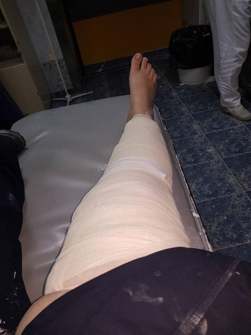 Ovako izgleda noga napadnute komunalne policajke