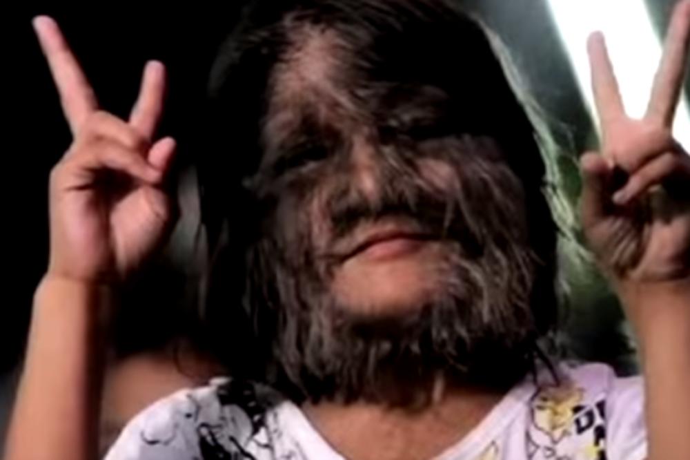 ZVALI SU JE DEVOJČICA VUKODLAK: Sada je uklonila sve dlake i svet je šokiran njenom transformacijom! (FOTO)