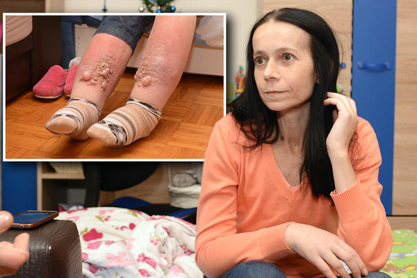TEŠKE NOGE, ŽIVE RANE NA TELU I ŽIVOT OD SOCIJALNE POMOĆI OD 18.000! Za Biljaninu bolest nema leka, a 12 godina je živela sasvim normalno
