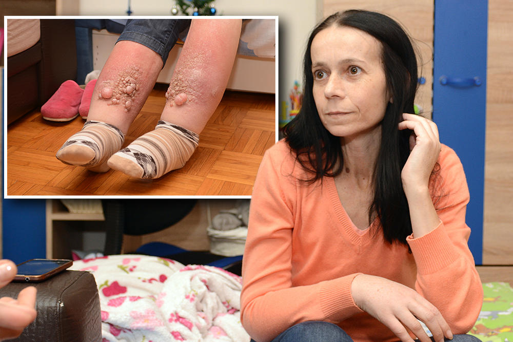 TEŠKE NOGE, ŽIVE RANE NA TELU I ŽIVOT OD SOCIJALNE POMOĆI OD 18.000! Za Biljaninu bolest nema leka, a 12 godina je živela sasvim normalno