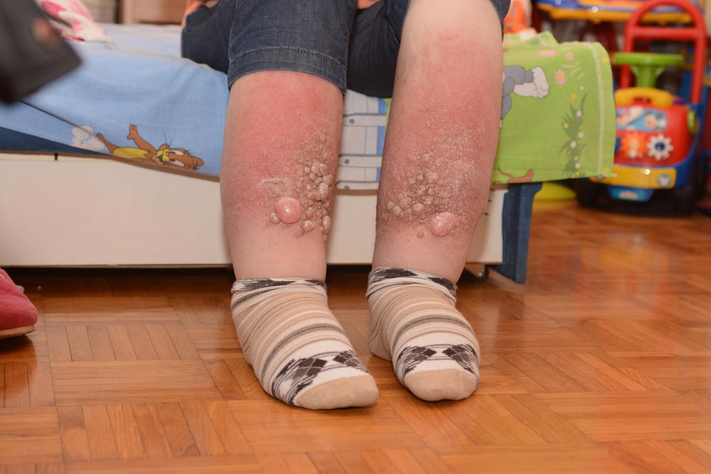 Biljanine noge konstantno otiču