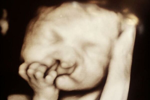 SAVETOVALI SU JOJ DA ZBOG DEFORMACIJE POBACI SINA: Ali ona nije odustala i danas mališan izgleda OVAKO! (FOTO)