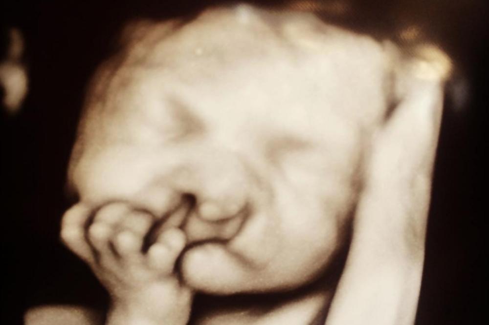 SAVETOVALI SU JOJ DA ZBOG DEFORMACIJE POBACI SINA: Ali ona nije odustala i danas mališan izgleda OVAKO! (FOTO)