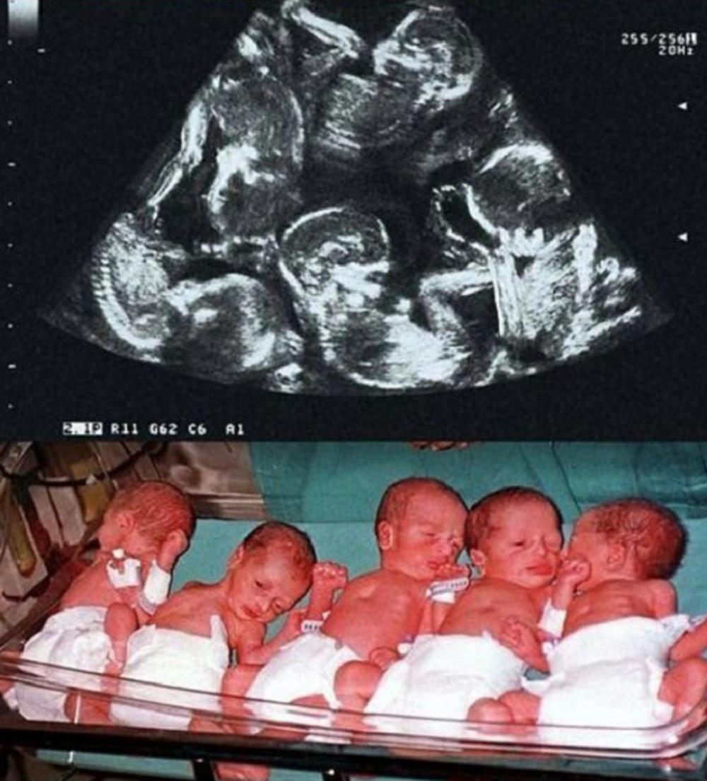 Petorke su rođene bez komplikacija