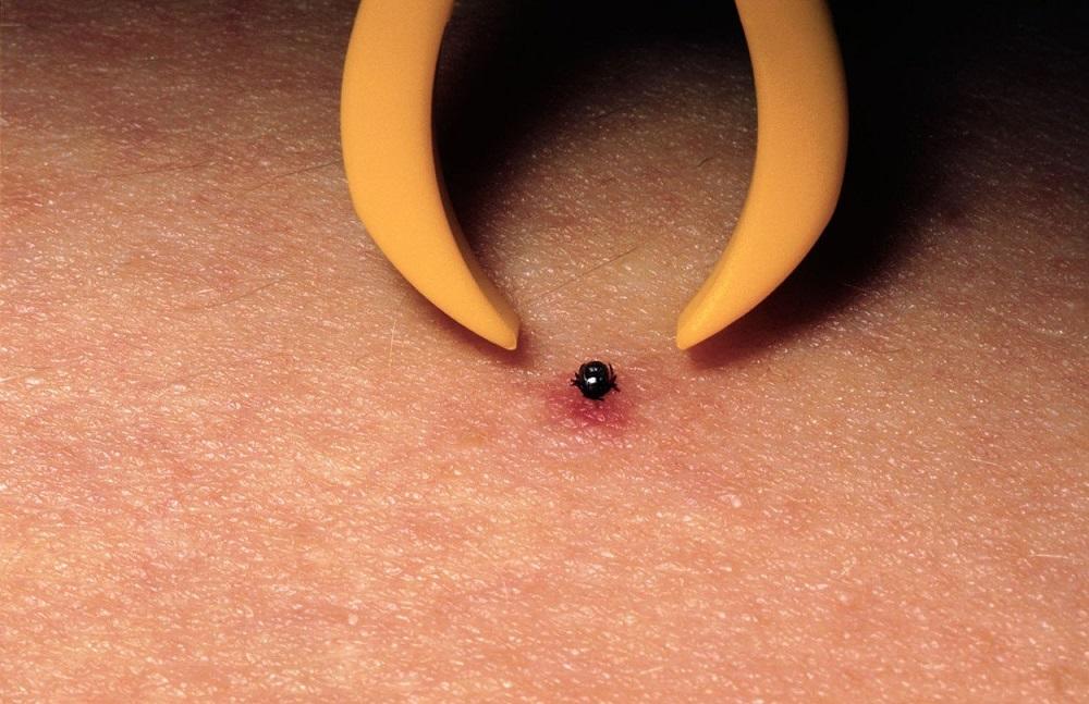 Kako se pravilno vadi krpelj?