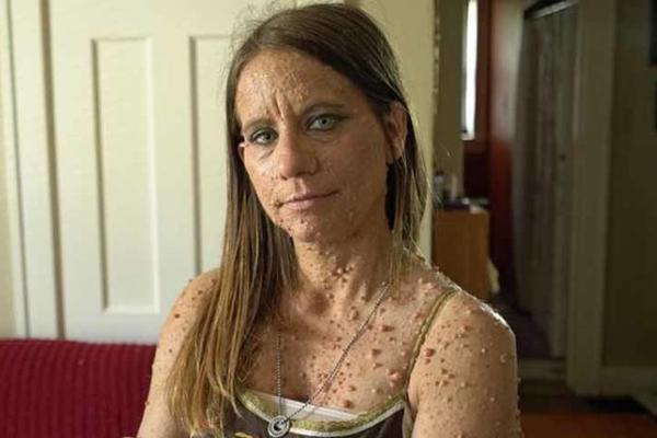 Libi je imala preko 6.000 izraslina po celom telu i preko 10 operacija! DANAS IZGLEDA POTPUNO DRUGAČIJE! (FOTO) (VIDEO)