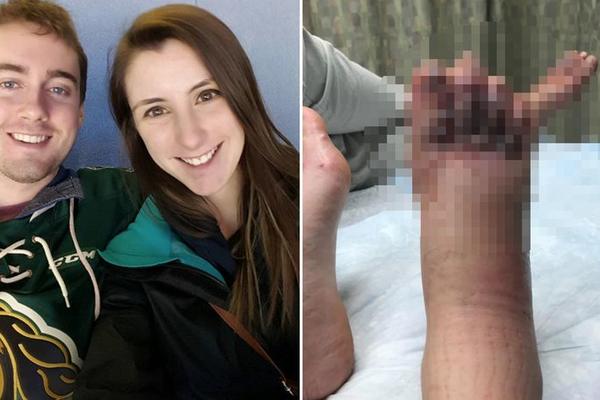 MISLILI SU DA IH JE UJEO INSEKT: Posle ove priče, dobro razmislite hoćete li ŠETATI BOSI PO PLAŽI! (FOTO)