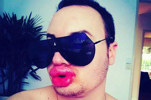 Napumpao usne da bi izgledao kao Merlin Monro! Kada ga vide na ulici, ljudi mu se SMEJU U LICE!