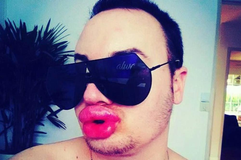 Napumpao usne da bi izgledao kao Merlin Monro! Kada ga vide na ulici, ljudi mu se SMEJU U LICE!