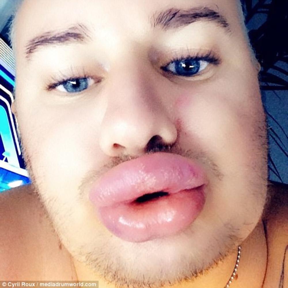 Napumpao usne da bi izgledao kao Merlin Monro