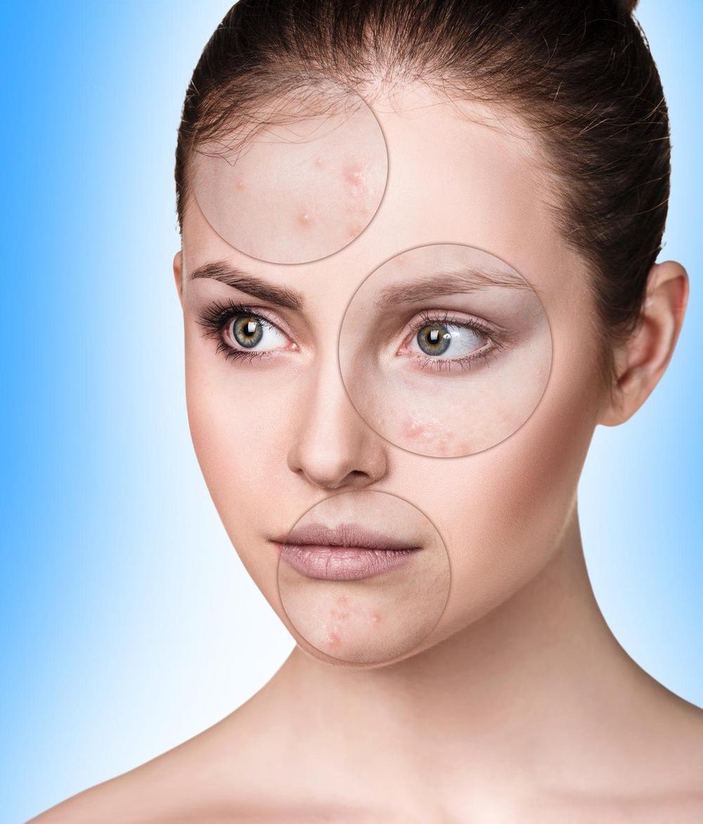 Otkrijte na vreme šta vam govori osip na licu