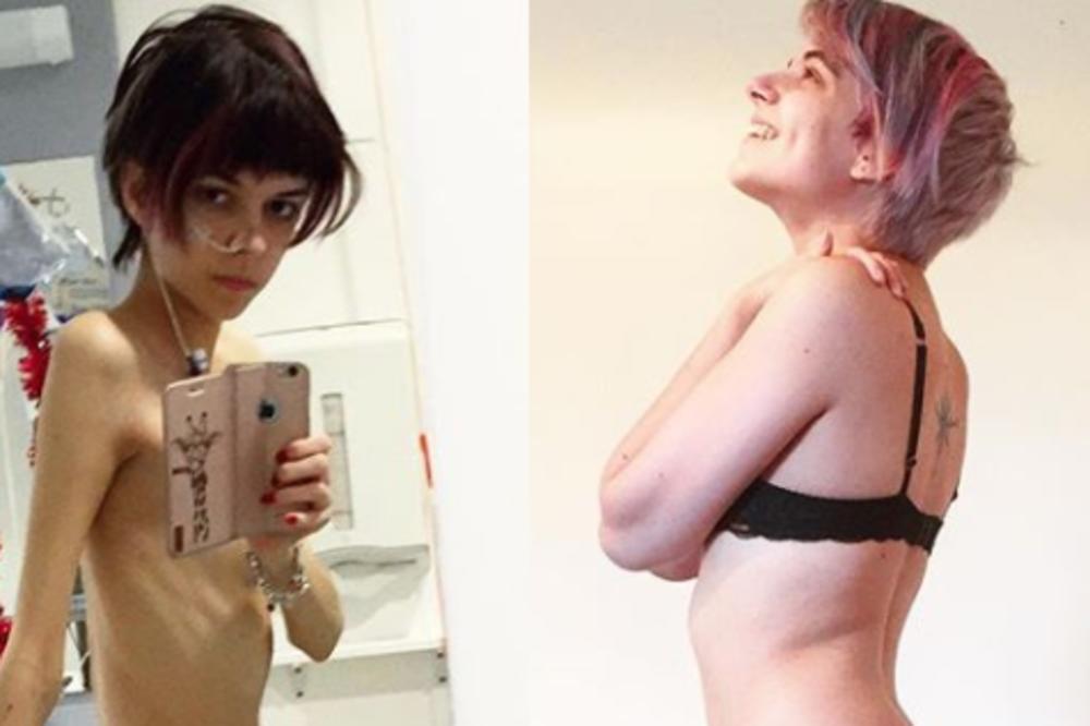 SA 20 GODINA TEŽILA JE KAO PETOGODIŠNJE DETE: Ona je uspela da pobedi ANOREKSIJU, a ovako je izgledao njen oporavak! (FOTO)