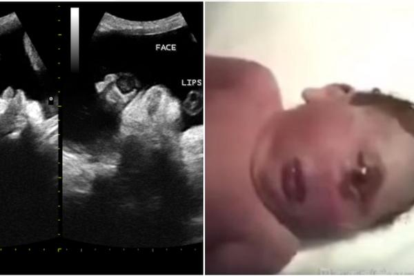 BEBE SE RAĐAJU SA JEDNIM VELIKIM OKOM NA ČELU i ne požive duže od jednog dana! Redak poremećaj dece najveći je strah OVIH trudnica! (VIDEO)