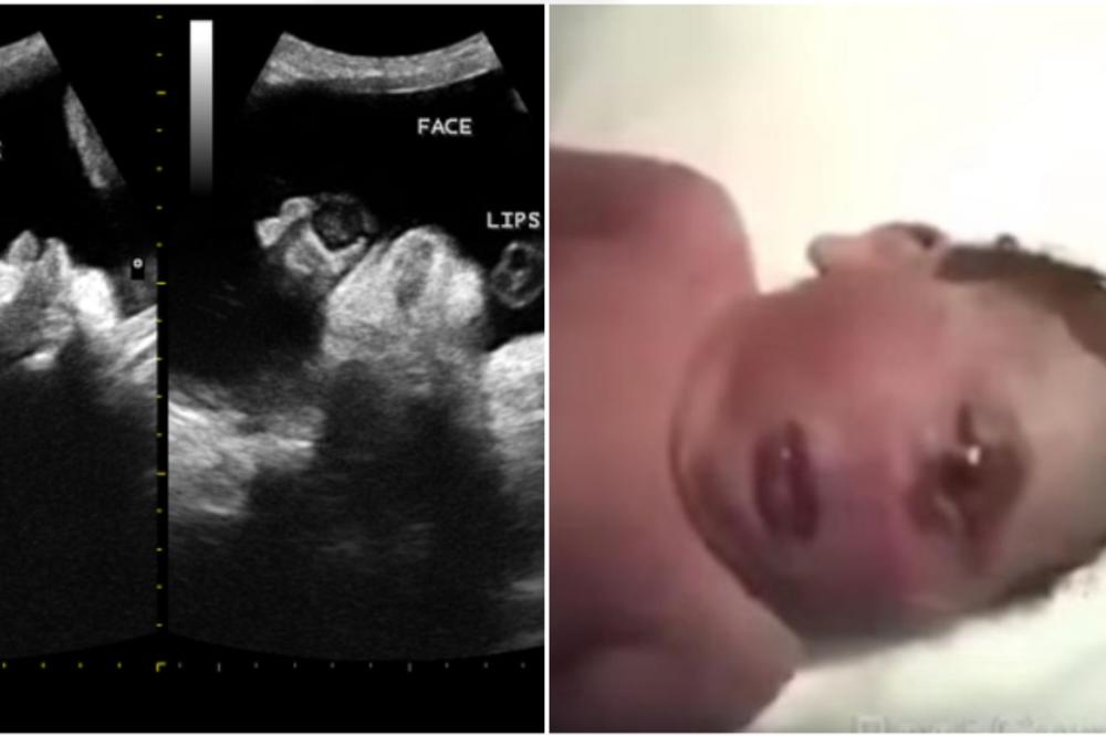 BEBE SE RAĐAJU SA JEDNIM VELIKIM OKOM NA ČELU i ne požive duže od jednog dana! Redak poremećaj dece najveći je strah OVIH trudnica! (VIDEO)