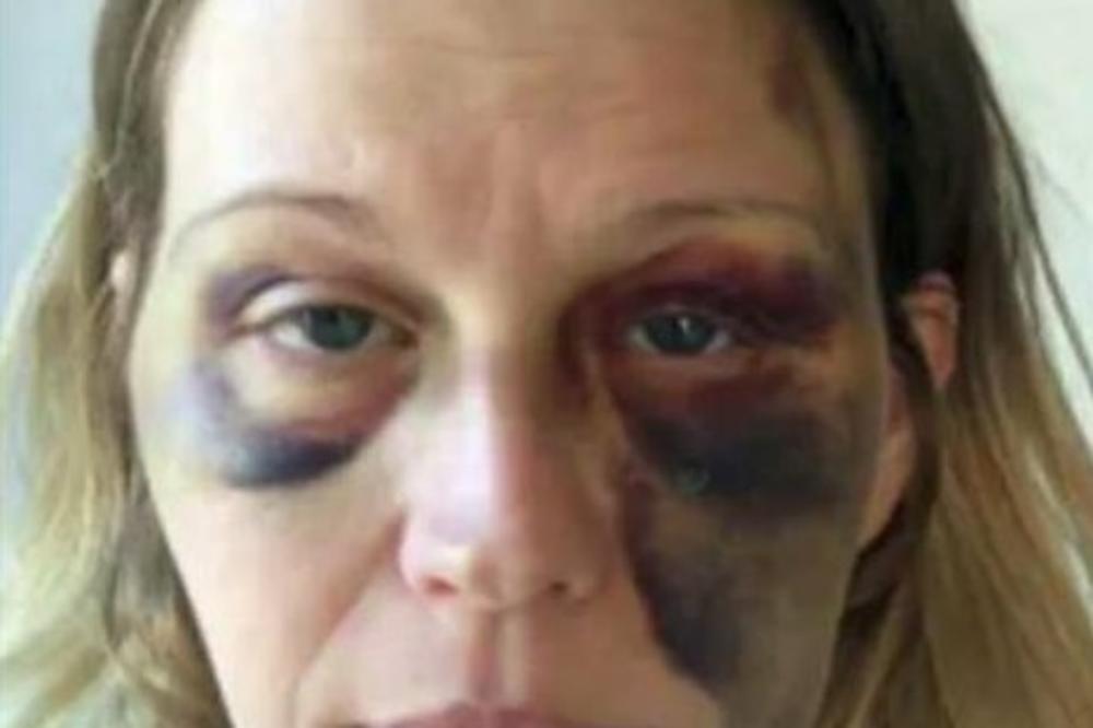 LEPO JE NAŠMINKAO: Fotografija žene koja je krvnički prebijena izazvala je komentare koji će vas razbesneti (FOTO)